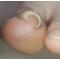 巻き爪が悩みの方へ